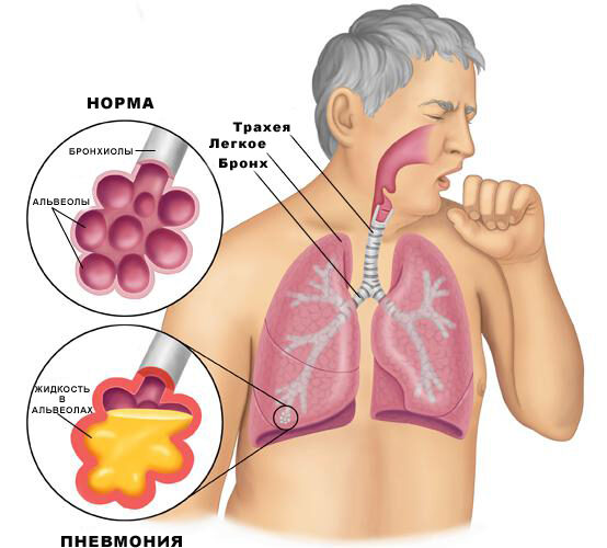 Pneumonia_anatomy_PI Профилактика пневмонии